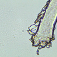 Schistosomiasis worm in urine sample