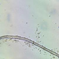 Schistosomiasis in semen sample Schistosomiasis in semen sample