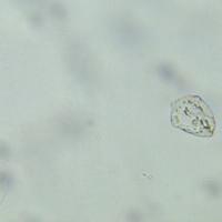 Schistosomiasis urine sample Schistosomiasis urine sample