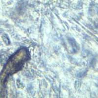 Schistosomiasis in vaginal wet slide  Schistosomiasis in vaginal wet slide