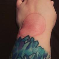 Cupping Therapy Session Cupping Therapy Session