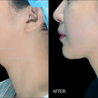 天鵝頸手術案例 天鵝頸手術案例