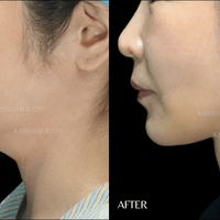 天鵝頸手術案例 天鵝頸手術案例