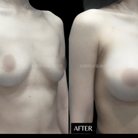 隆乳術後案例 隆乳術後案例
