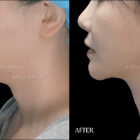 天鵝頸手術案例 天鵝頸手術案例