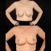 Breast Reduction Before and After Surgery at Sussex Breast Surgery Breast Reduction Before and After Surgery at Sussex Breast Surgery