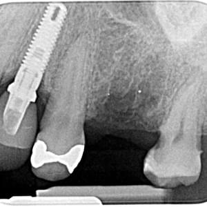 Radiografía periapical digital dental Radiografía periapical digital dental