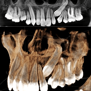 CBCT dientes incluidos CBCT dientes incluidos