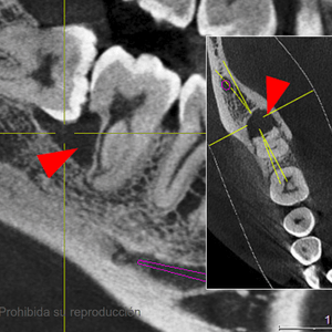 CBCT tercer molar CBCT tercer molar