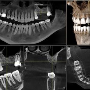 Scanner cone-beam CBCT de alta resolución y mínima dosis Scanner cone-beam CBCT de alta resolución y mínima dosis