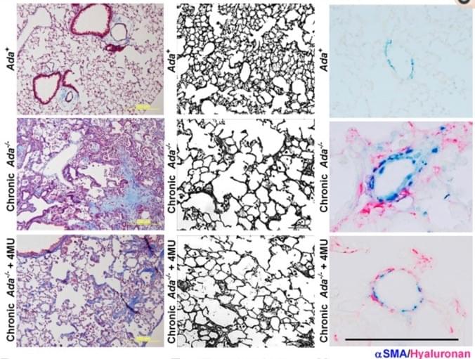 Adenosine and Hyaluronan modulate lung fibrosis and pulmonary hypertension in Combined Pulmonary Fibrosis and Emphysema (CPFE) Adenosine and Hyaluronan modulate lung fibrosis and pulmonary hypertension in Combined Pulmonary Fibrosis and Emphysema (CPFE)