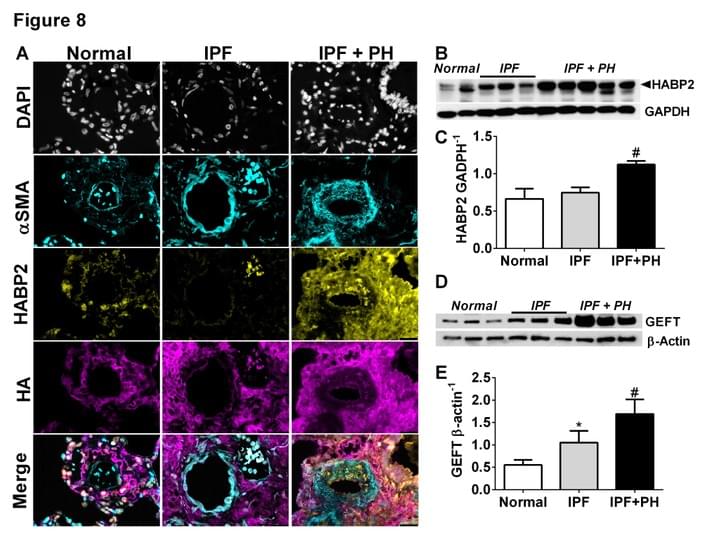 Hyaluronan and Group III Pulmonary Hypertension Hyaluronan and Group III Pulmonary Hypertension
