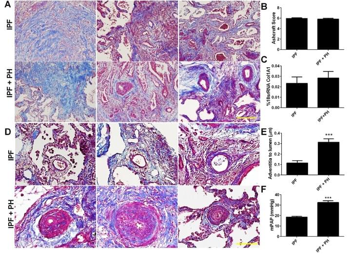 Group III Pulmonary Hypertension (PH) Group III Pulmonary Hypertension (PH)