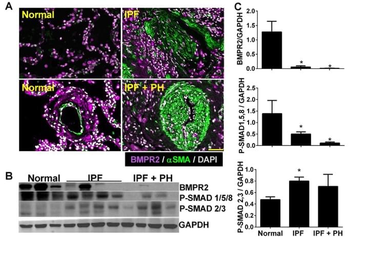 BMPR2 IPF and lung Fibrosis BMPR2 IPF and lung Fibrosis