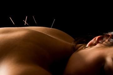 acupuncture acupuncture