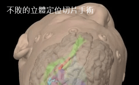 莊銘榮 不敗的Biopsy: 不敗的立體定位腦部腫瘤切片手術 莊銘榮 不敗的Biopsy: 不敗的立體定位腦部腫瘤切片手術