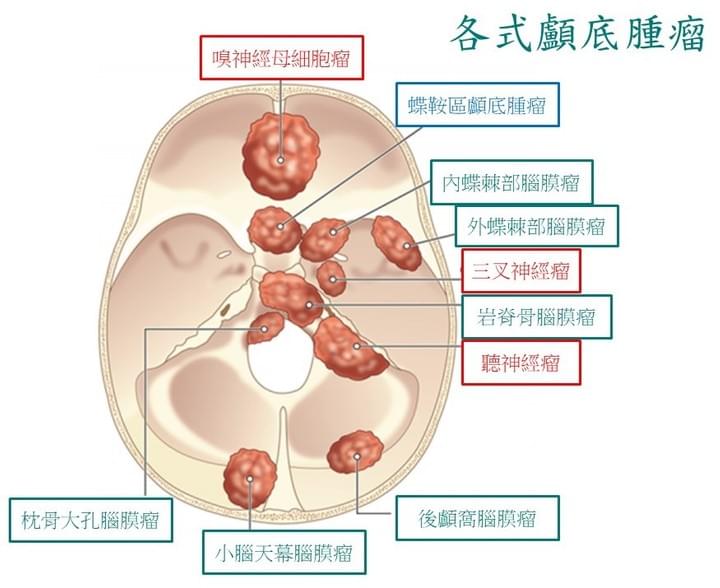 神經外科的頂尖高手: 顱底手術與顱底團隊 BY高雄長庚莊銘榮 神經外科的頂尖高手: 顱底手術與顱底團隊 BY高雄長庚莊銘榮