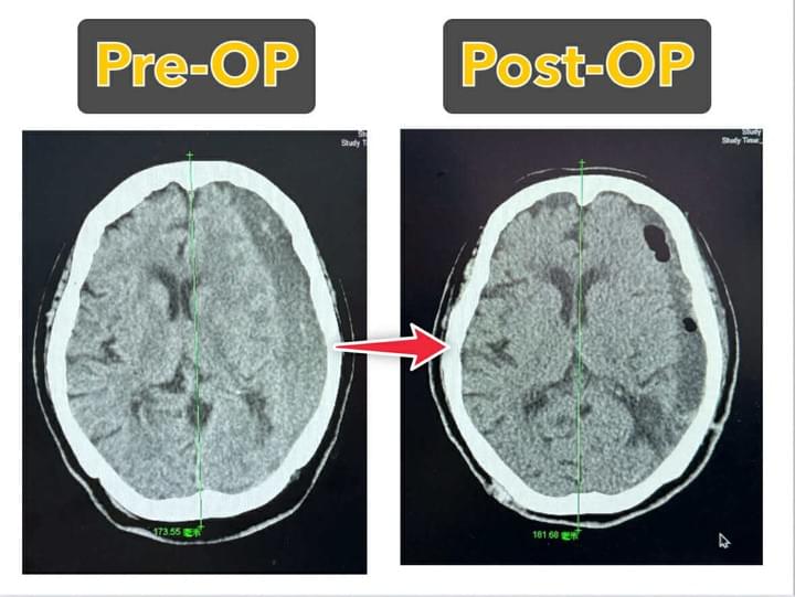 莊銘榮、神經外科、慢性硬腦膜下出血、內視鏡、微創 莊銘榮、神經外科、慢性硬腦膜下出血、內視鏡、微創