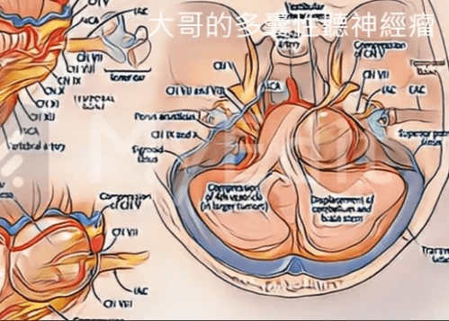 大哥的多囊性聽神經瘤, 高雄長庚莊銘榮 大哥的多囊性聽神經瘤, 高雄長庚莊銘榮