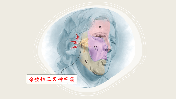 顱底神經外科的小確幸: 原發性三叉神經痛的三叉神經顯微血管減壓手術 BY高雄長庚莊銘榮 顱底神經外科的小確幸: 原發性三叉神經痛的三叉神經顯微血管減壓手術 BY高雄長庚莊銘榮