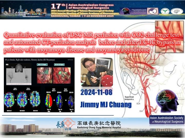 毛毛樣病、腦中風、搭橋手術、顱內顱外血管接合手術、莊銘榮、高雄長庚 毛毛樣病、腦中風、搭橋手術、顱內顱外血管接合手術、莊銘榮、高雄長庚