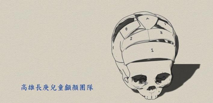 高雄長庚兒童顱顏團隊的複雜顱顏重建手術與兒童顱縫早閉治療 高雄長庚兒童顱顏團隊的複雜顱顏重建手術與兒童顱縫早閉治療