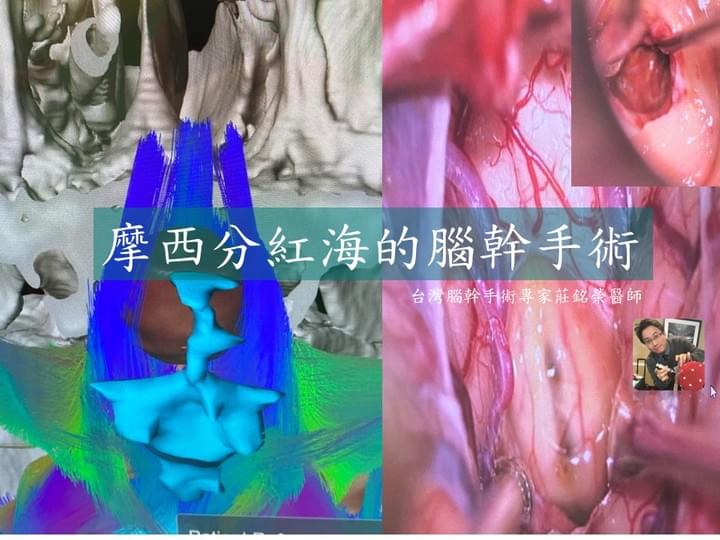 莊銘榮; 腦幹手術; 腦幹腫瘤; 腦瘤; 顱底手術; 高雄長庚 莊銘榮; 腦幹手術; 腦幹腫瘤; 腦瘤; 顱底手術; 高雄長庚