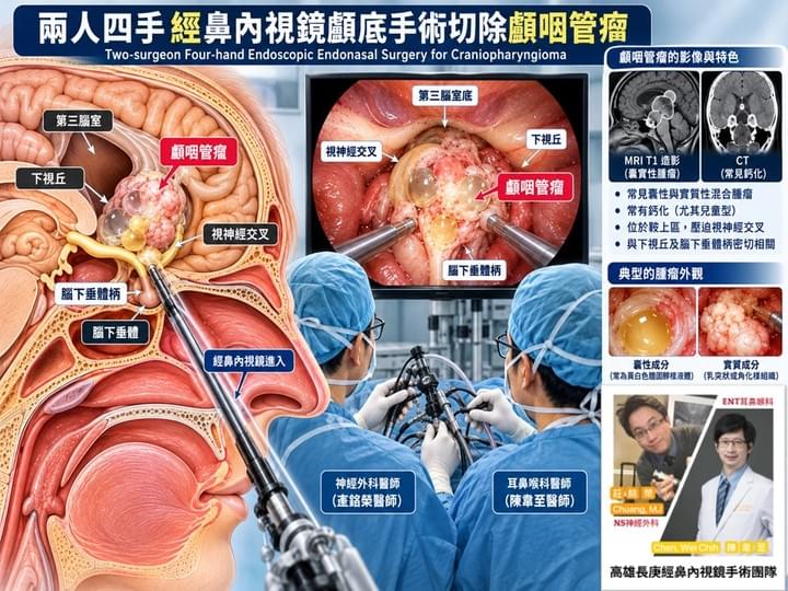 經鼻內視鏡、微創、顱咽管瘤、神經外科、腦瘤、顱底、高雄長庚 經鼻內視鏡、微創、顱咽管瘤、神經外科、腦瘤、顱底、高雄長庚