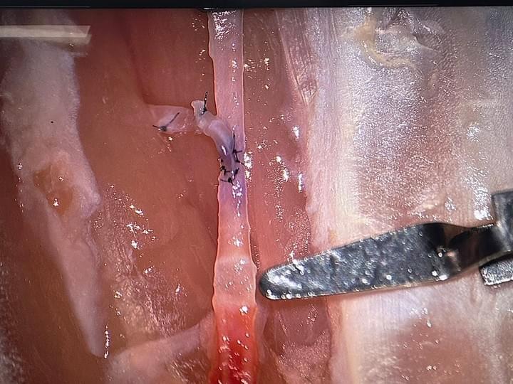 搭橋手術、腦血管顯微縫合、毛毛樣病、高雄長庚神經外科、莊銘榮 搭橋手術、腦血管顯微縫合、毛毛樣病、高雄長庚神經外科、莊銘榮