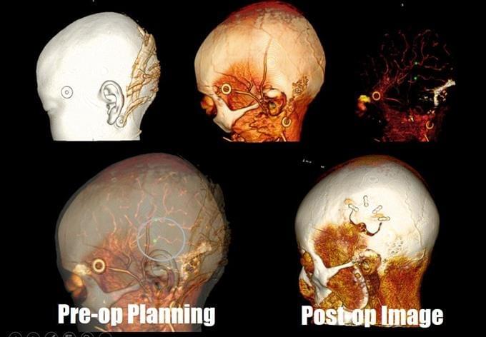 神經外科的虛擬實境與擴增實境 BY高雄長庚莊銘榮 神經外科的虛擬實境與擴增實境 BY高雄長庚莊銘榮