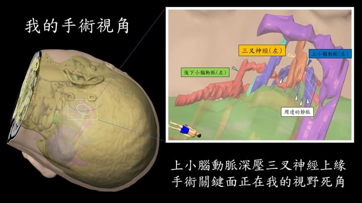 莊銘榮 三叉神經痛 醫病共享決策 莊銘榮 三叉神經痛 醫病共享決策