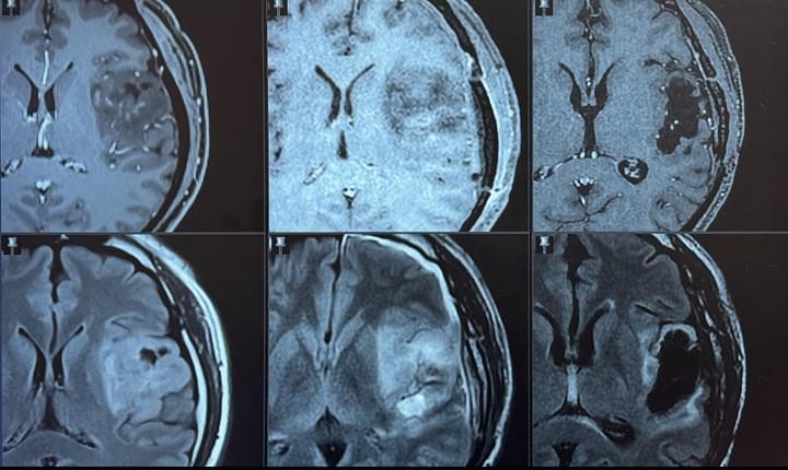 腦瘤、神經外科、莊銘榮、高雄長庚、清醒手術、膠質瘤、島葉 腦瘤、神經外科、莊銘榮、高雄長庚、清醒手術、膠質瘤、島葉