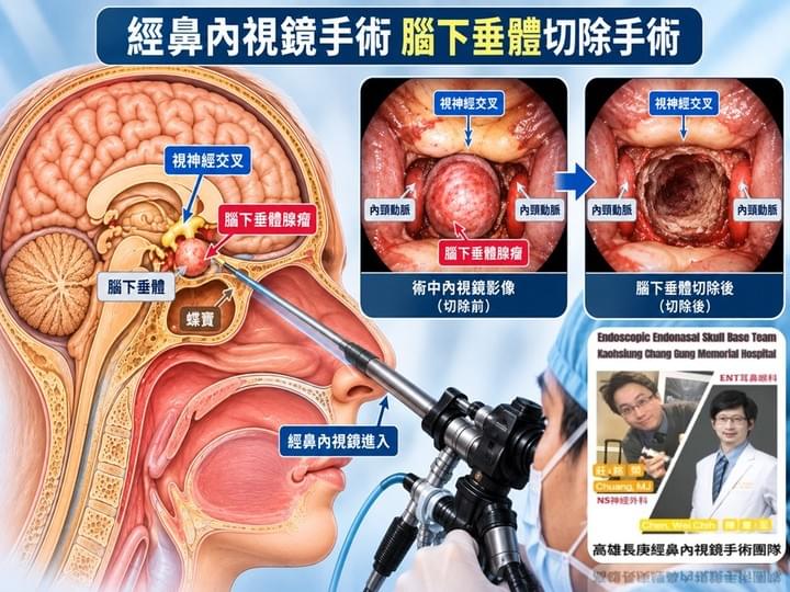 腦下垂體腺瘤、經鼻內視鏡顱底手術、微創、高雄長庚 腦下垂體腺瘤、經鼻內視鏡顱底手術、微創、高雄長庚