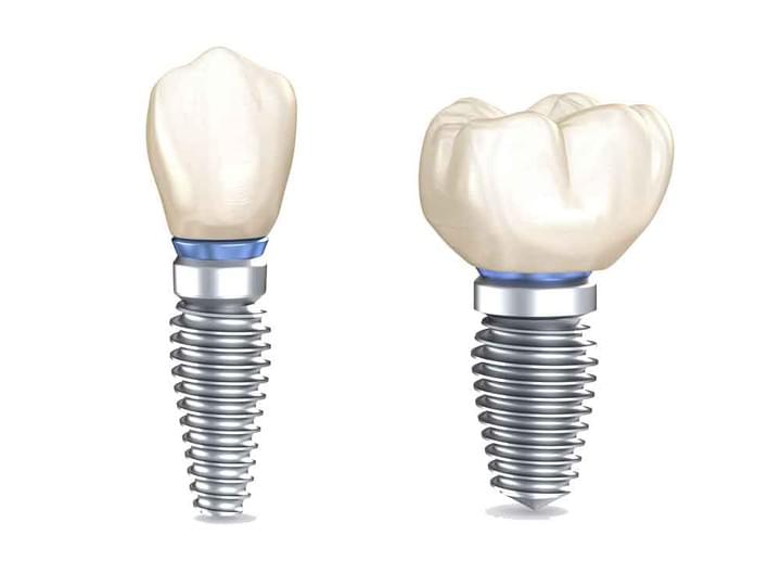 Dental Implants image Dental Implants image