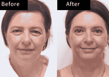 Perfecting your facial harmony is our goal. Our rhinoplasty and facial feature surgeries are designed to improve proportion and symmetry, helping you look and feel your best. Trust our experienced team for natural, stunning results. Nose & Facial Features Our Cosmetic Surgery Services 主要做整形手术 Perfecting your facial harmony is our goal. Our rhinoplasty and facial feature surgeries are designed to improve proportion and symmetry, helping you look and feel your best. Trust our experienced team for natural, stunning results. Nose & Facial Features Our Cosmetic Surgery Services 主要做整形手术