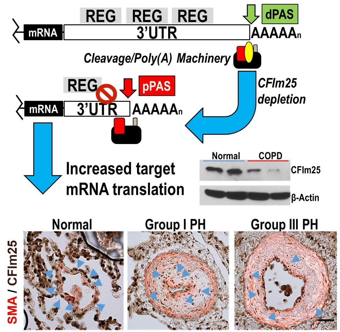 Alternative Polyadenylation Pulmonary Hypertension Alternative Polyadenylation Pulmonary Hypertension