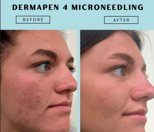 Dermapen 4-Microneedling