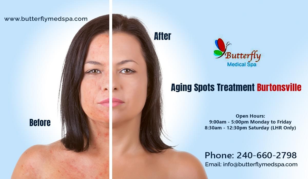 Aging Spots Treatment Burtonsville Aging Spots Treatment Burtonsville