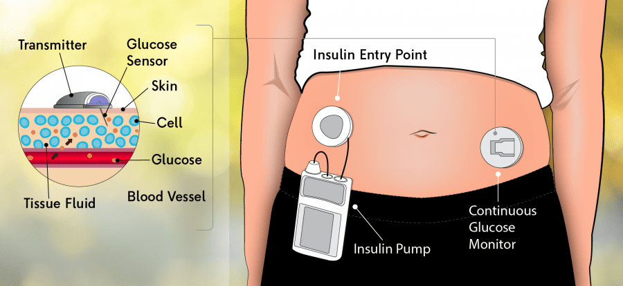 diagram of a continuous glucose monitor for diabetes connecting to an insulin pump diagram of a continuous glucose monitor for diabetes connecting to an insulin pump