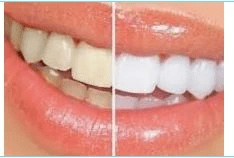 Résultats avant/après d’une séance de blanchiment dentaire professionnel : dents visiblement plus blanches après application du gel éclaircissant. Formation sans CPF chez Studio Beauté. Résultats avant/après d’une séance de blanchiment dentaire professionnel : dents visiblement plus blanches après application du gel éclaircissant. Formation sans CPF chez Studio Beauté.