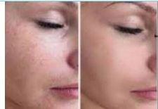 Résultats avant/après d’une séance de microneedling BB Glow : peau revitalisée, imperfections atténuées et teint unifié. Formation professionnelle sans CPF chez Studio Beauté. Résultats avant/après d’une séance de microneedling BB Glow : peau revitalisée, imperfections atténuées et teint unifié. Formation professionnelle sans CPF chez Studio Beauté.