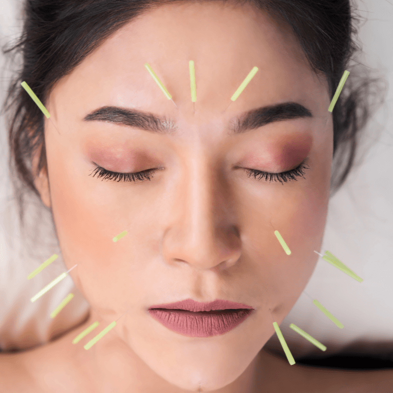 Cosmetic acupuncture face lift FAQ Cosmetic acupuncture face lift FAQ