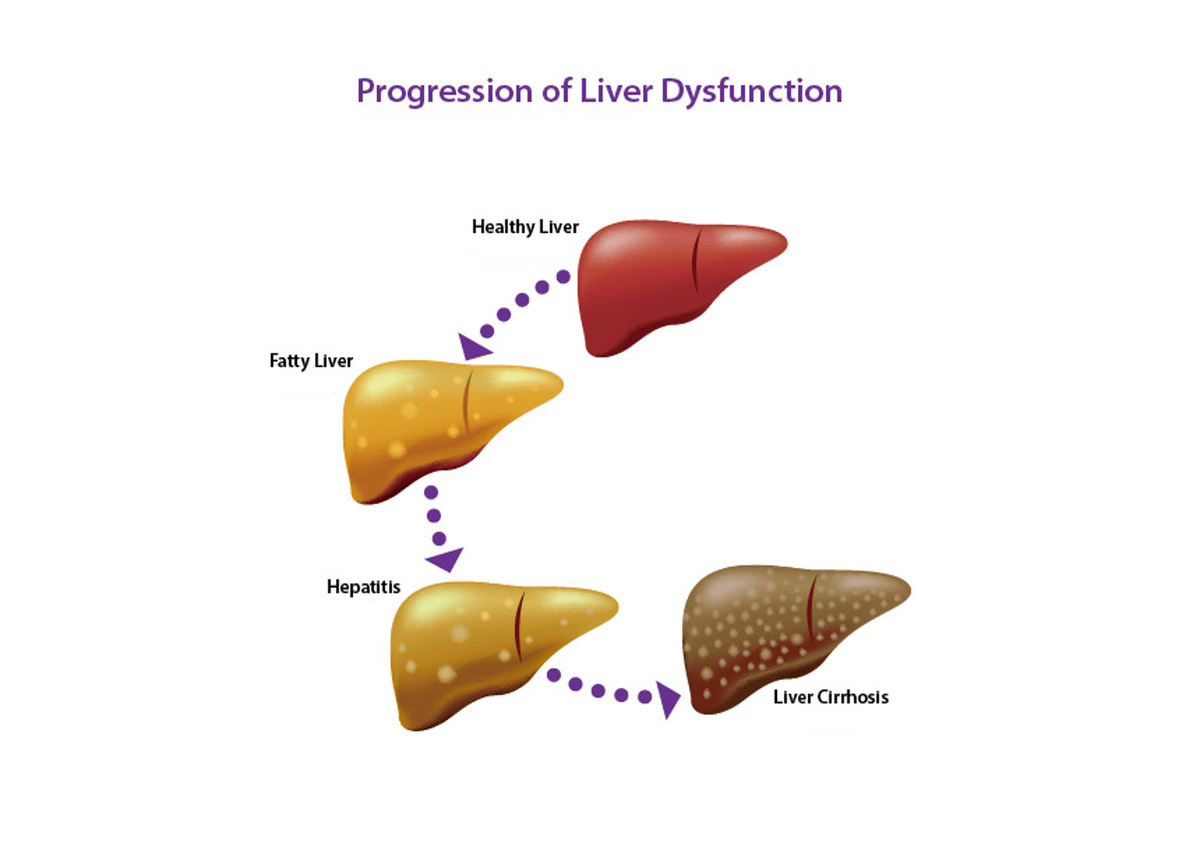 肝功能異常的各個階段 肝功能異常的各個階段