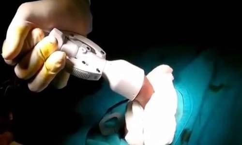 Mấy tuổi nên cắt bao quy đầu Mấy tuổi nên cắt bao quy đầu
