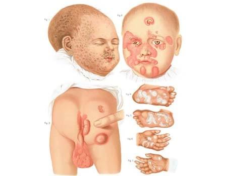 Hình ảnh giang mai bẩm sinh Hình ảnh giang mai bẩm sinh