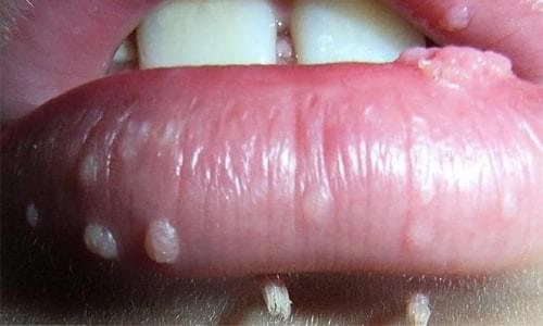 Hình ảnh sùi mào gà mọc riêng lẻ bên ngoài vành môi Hình ảnh sùi mào gà mọc riêng lẻ bên ngoài vành môi