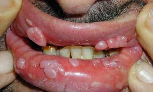 Hình ảnh sùi mào gà ở môi Hình ảnh sùi mào gà ở môi