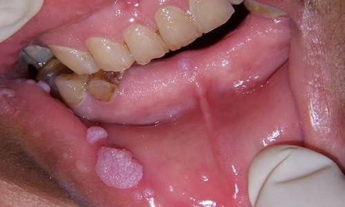 Biểu hiện của bệnh sùi mào gà ở miệng Biểu hiện của bệnh sùi mào gà ở miệng