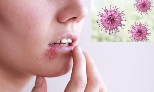 virus hsv là gì virus hsv là gì