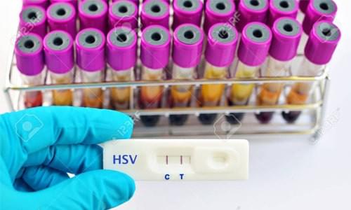 Xét nghiệm hsv ở đâu Xét nghiệm hsv ở đâu